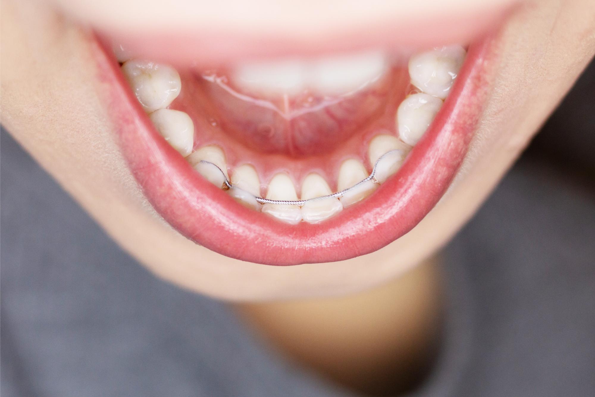 Retainers
